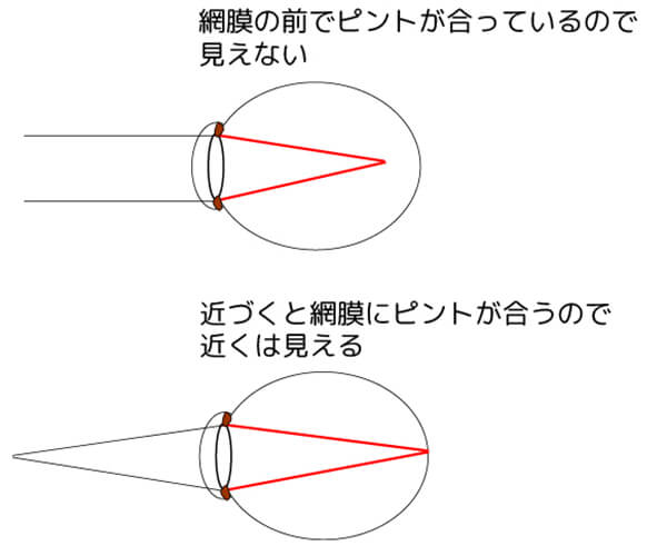 近視は眼球が大きいので、網膜の前でピントが合っています