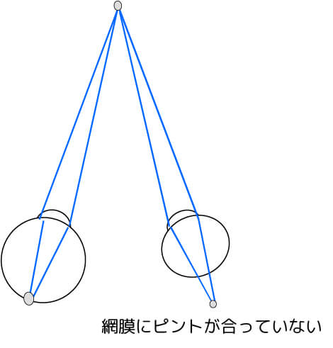 不同視弱視