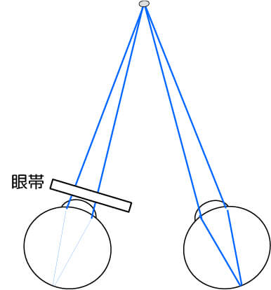 形態覚遮断弱視